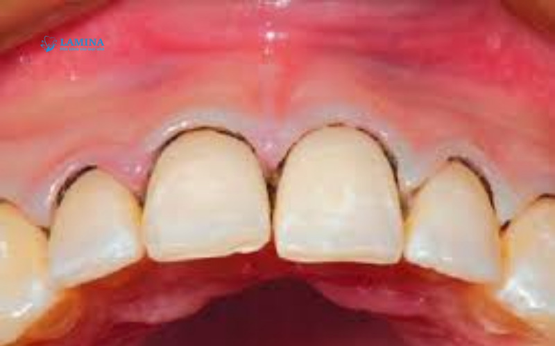 Viêm nha chu nặng