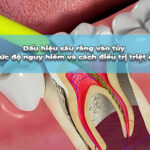 sâu răng vào tuỷ
