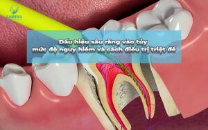 sâu răng vào tuỷ