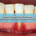 tụt lợi hàm dưới