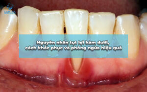 tụt lợi hàm dưới