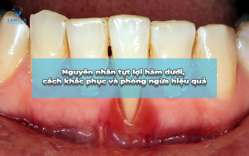 tụt lợi hàm dưới