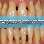 viêm nha chu là bị gì