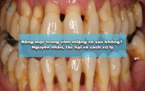 viêm nha chu là bị gì