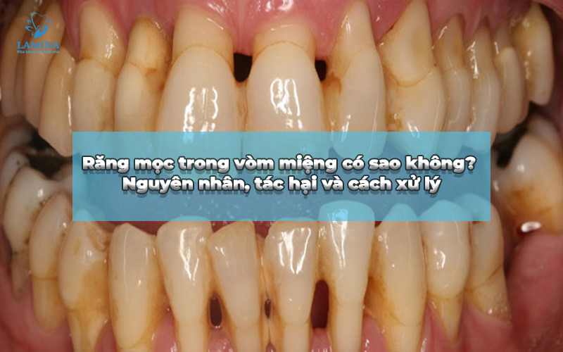 viêm nha chu là bị gì