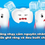 răng nhạy cảm