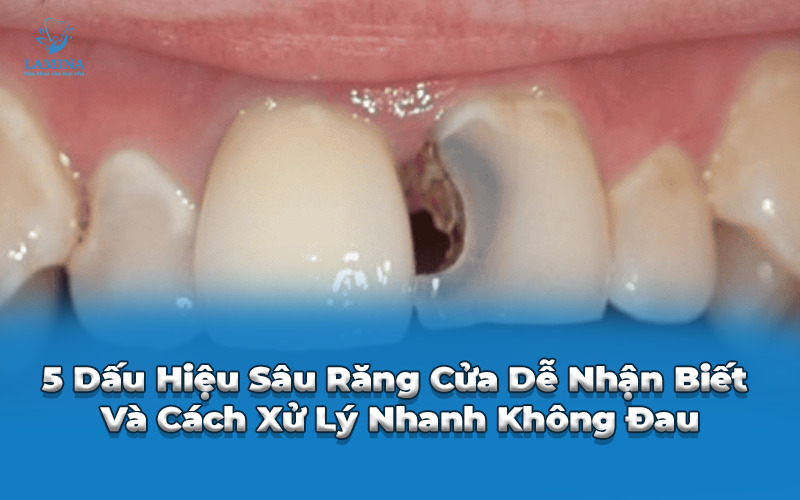 sâu răng cửa