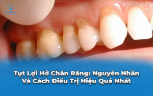 tụt lợi hở chân răng