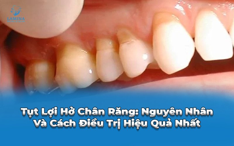tụt lợi hở chân răng