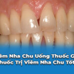 viêm nha chu uống thuốc gì