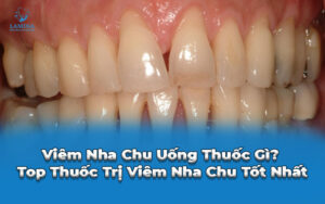 viêm nha chu uống thuốc gì