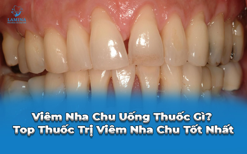 viêm nha chu uống thuốc gì