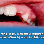 áp xe răng