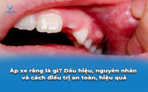 áp xe răng
