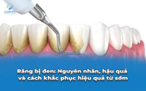 lấy cao răng có lâu không?