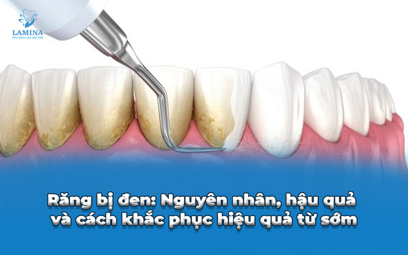 lấy cao răng có lâu không?