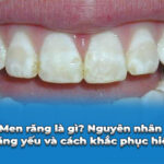 men răng yếu