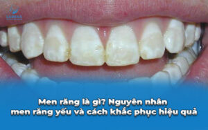 men răng yếu