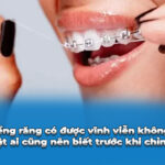 niềng răng có được vĩnh viễn không