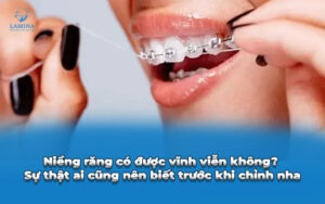 niềng răng có được vĩnh viễn không