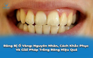 bìa răng bị ố vàng