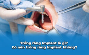 trồng răng implant