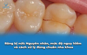răng bị nứt