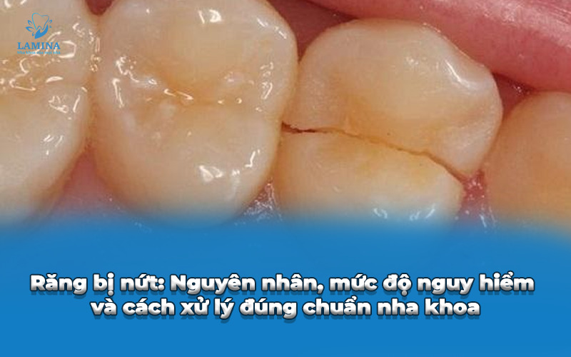răng bị nứt