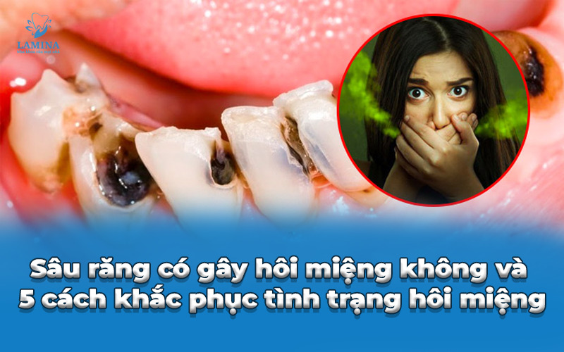 sâu răng có gây hôi miệng không