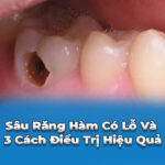 sâu răng hàm có lỗ