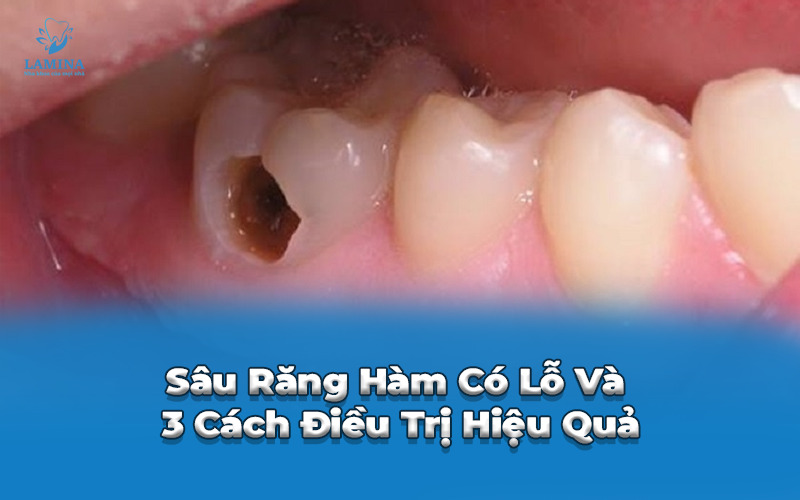 sâu răng hàm có lỗ