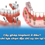 cấy ghép implant ở đâu