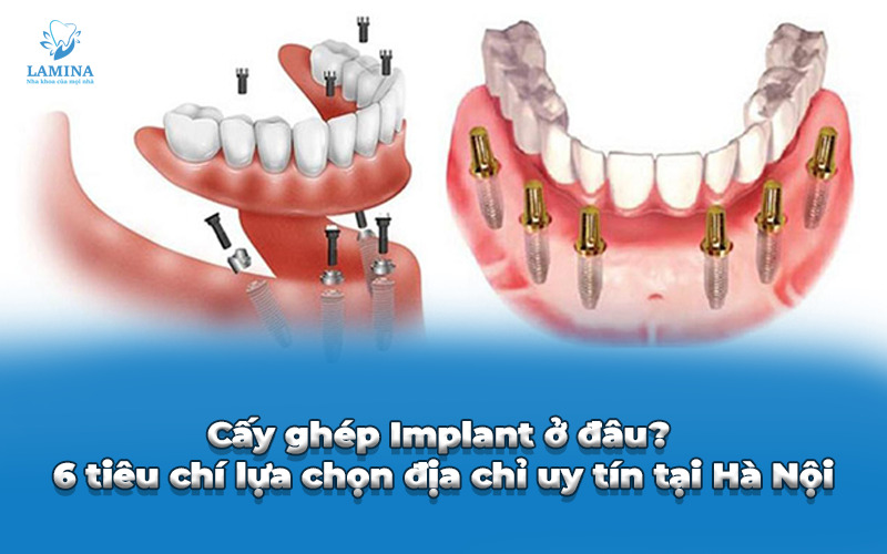 cấy ghép implant ở đâu
