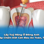 lấy tuỷ răng ở Đông Anh