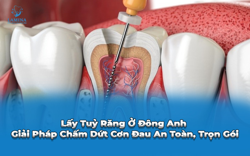 lấy tuỷ răng ở Đông Anh