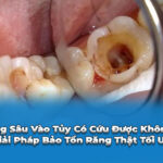 răng sâu vào tuỷ có cứu được không