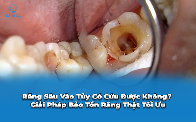 răng sâu vào tuỷ có cứu được không