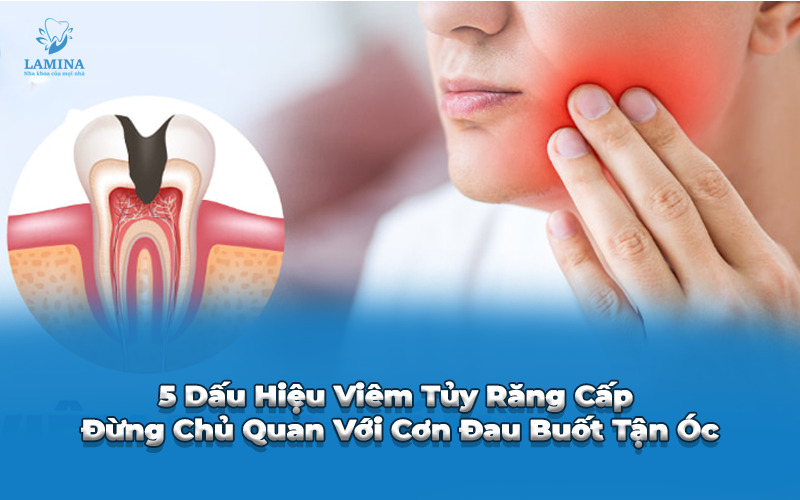 dấu hiệu viêm tuỷ răng cấp
