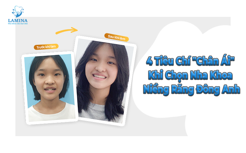 niềng răng uy tín đông anh